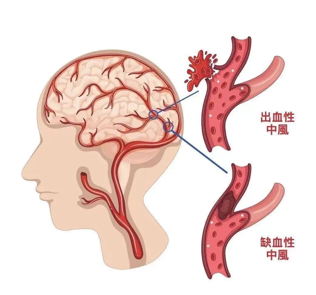 哪些人群易患中风?