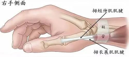 "手机手"是桡骨茎突狭窄性腱鞘炎,属于腱鞘炎的一种,由于腱鞘反复的