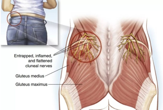 是由于臀上皮神经在穿过髂嵴部位受到卡压所产生的腰臀部弥散性疼痛