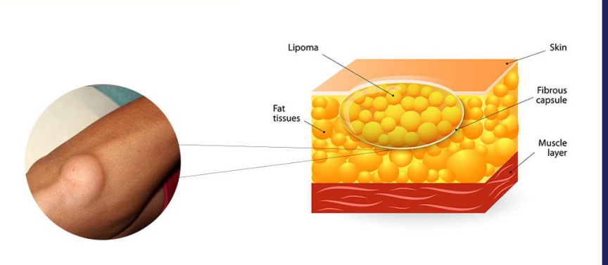 脂肪瘤结构模式图