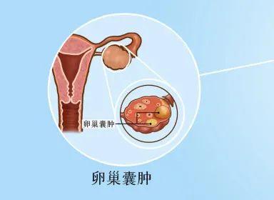 12岁女孩条毽子操剧烈腹痛不得不切除输卵管