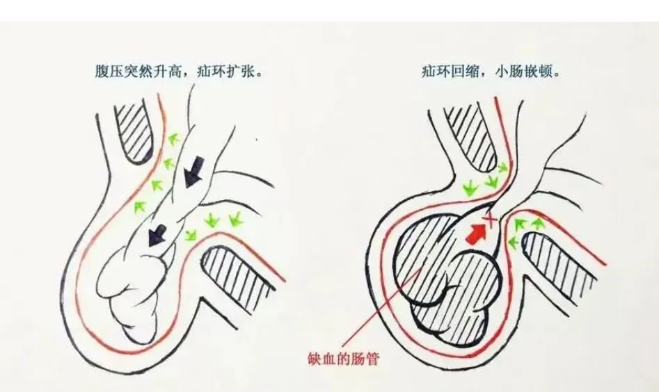 为"右侧腹股沟疝嵌顿导致完全性小肠梗阻,有肠管绞窄缺血坏死可能