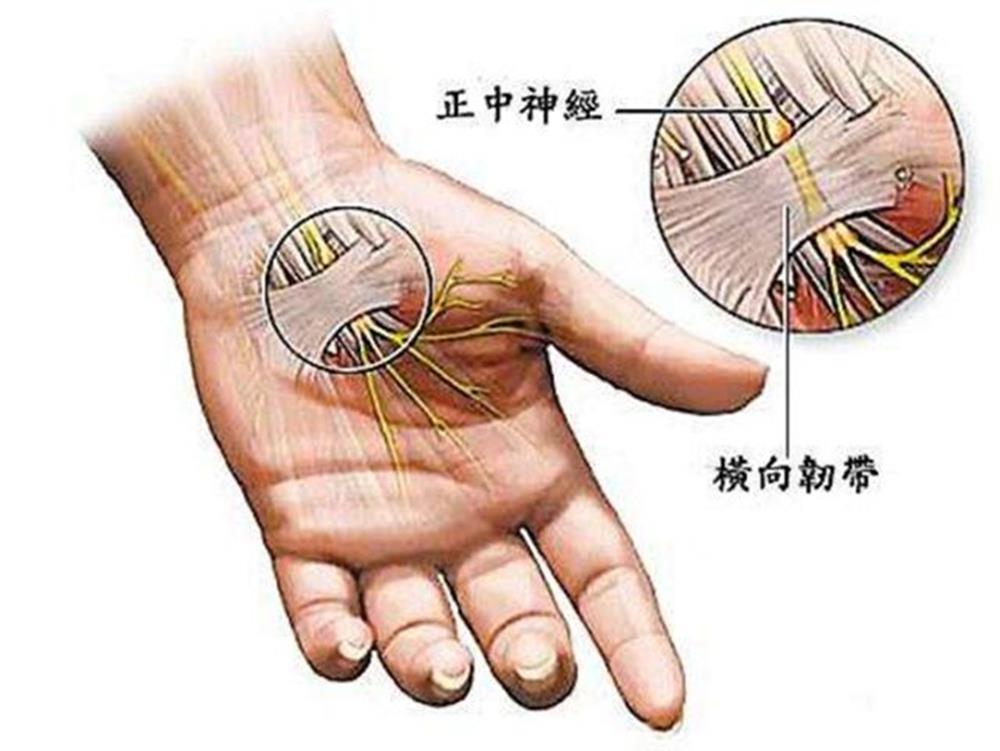 时,正中神经便会受到挤压,从而引发大拇指,食指,中指及部分环指麻木