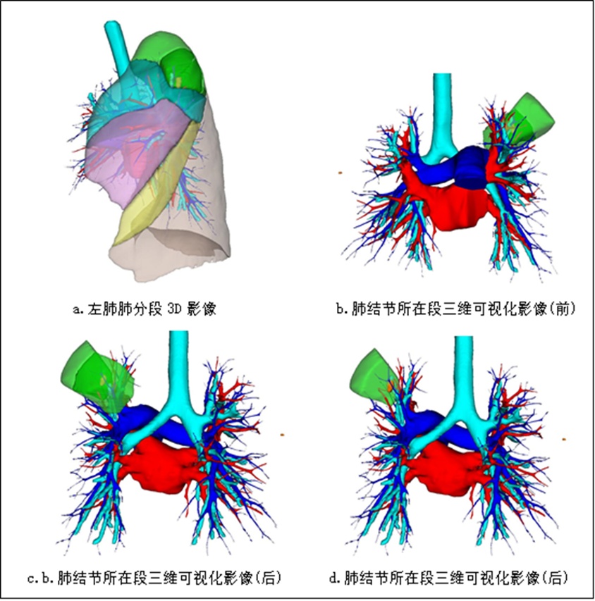 瑞金新技术（九）| 胸部CT三维重建辅助肺小结节手术规划