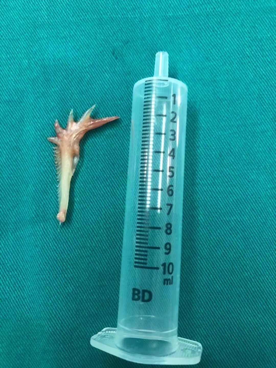 只因一根鱼刺10个科室30位专家参与大抢救