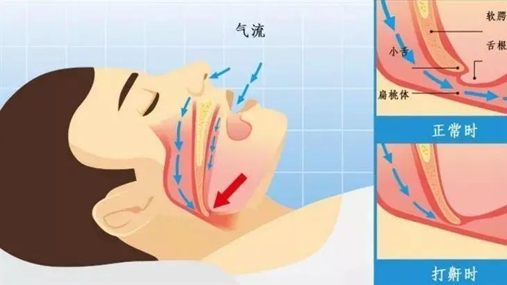 然而,如果个体存在扁桃体肥大,鼻息肉,舌体肥大,畸形,肥