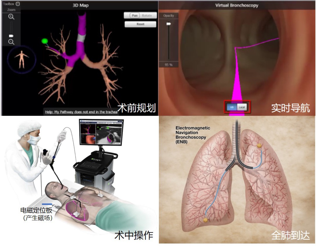 对付磨玻璃结节的新武器，气管里的“导航系统“来了！