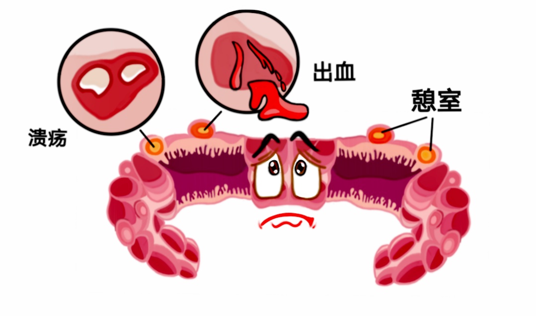 专家解析：消化道出血的常见原因及应对策略