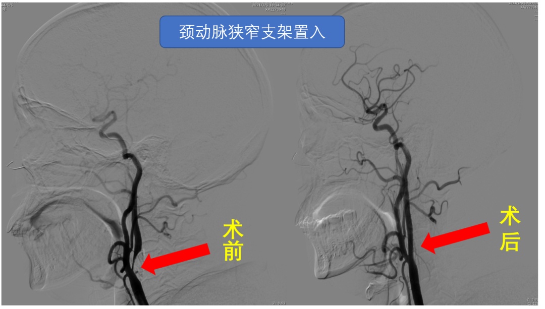 出血性脑血管疾病