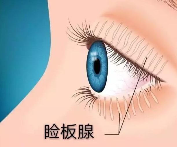 眼屎是睑板腺分泌液与眼睛中的杂质混合形成的物质.