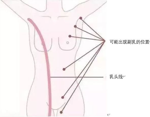 【健康科普】多余的“副乳”需要外科手术吗？(图2)