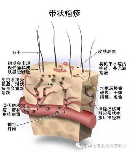 q5:為什麼會發生帶狀皰疹後神經痛?