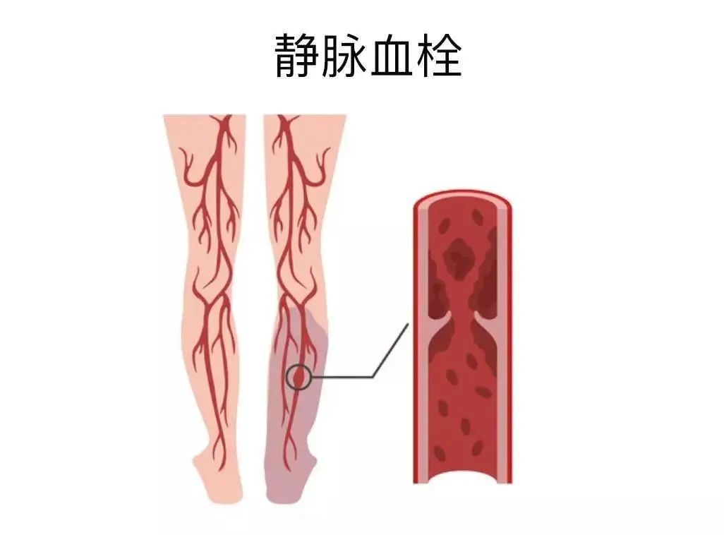 静脉血栓常堵在哪?