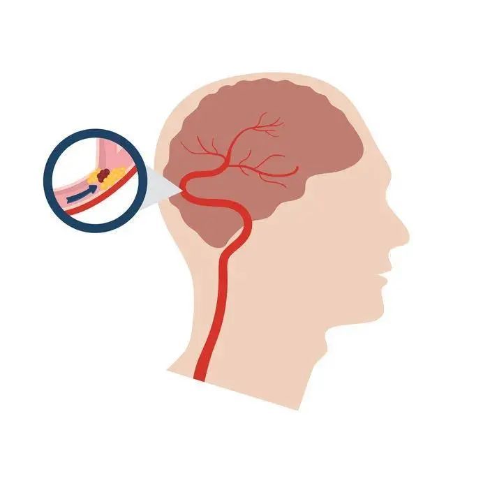 脑梗则是颈动脉或颅内血管堵塞了,导致脑缺血,也就是老百姓口中的