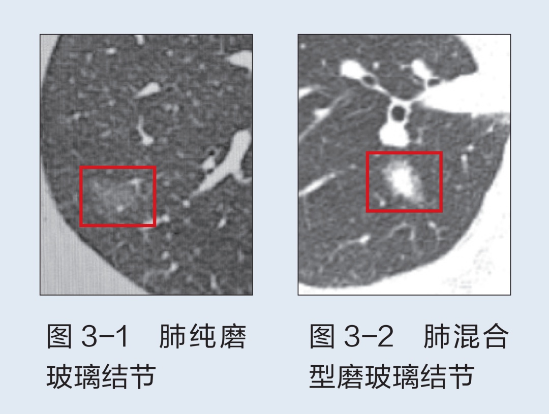 體檢查出磨玻璃結節就是癌?到底要緊伐?