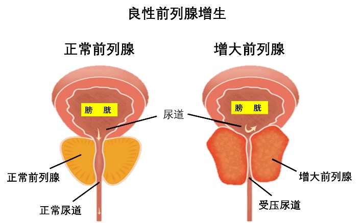 【长征病例】介入手术后,患者插了两个月的导尿管终于拔掉了