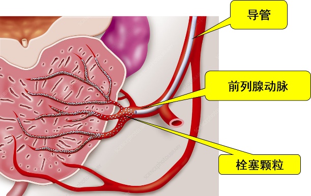 【长征病例】介入手术后,患者插了两个月的导尿管终于拔掉了