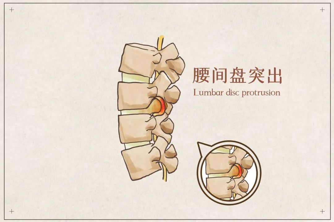 等于被过度使用,时间一长,他们将加速老化,腰椎间盘突出,骨刺也该找