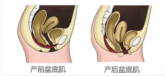 阴壁膨出有什么危害图片