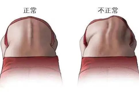胸椎呈s状侧弯图片