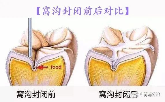 窝沟封闭过程图解图片