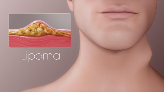 我的自画像 — 脂肪瘤(lipoma)