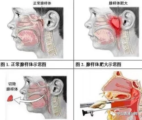 关于儿童腺样体肥大 这些知识家长需掌握 上观新闻