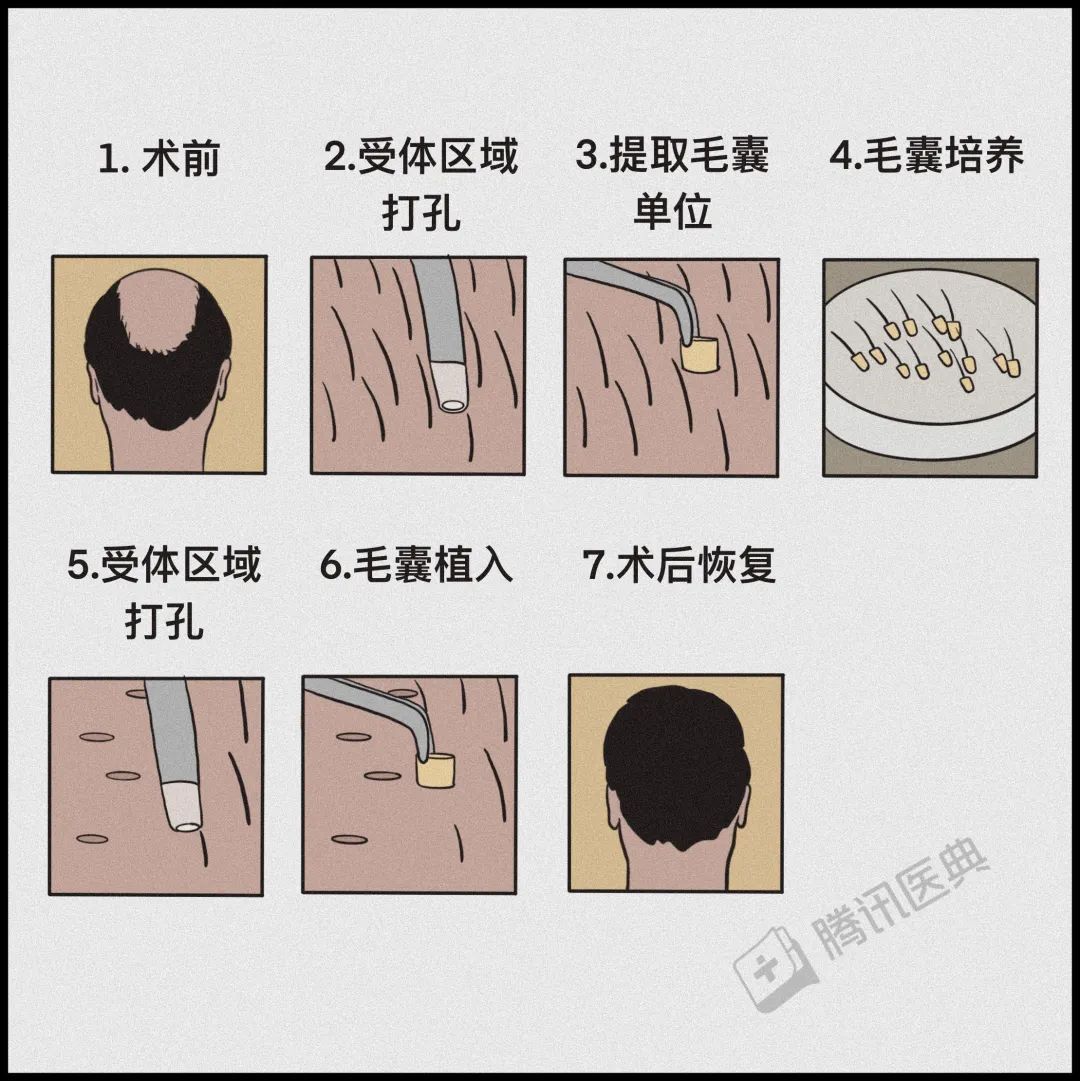 激光疗法有什么作用一篇帮人类打败脱发的文章（转给身边的他和她）_https://www.jmylbn.com_新闻资讯_第21张