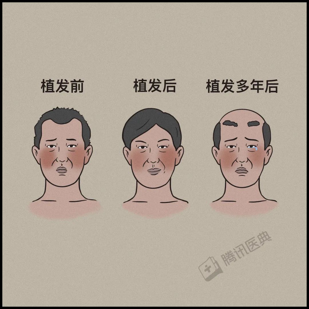 激光疗法有什么作用一篇帮人类打败脱发的文章（转给身边的他和她）_https://www.jmylbn.com_新闻资讯_第24张