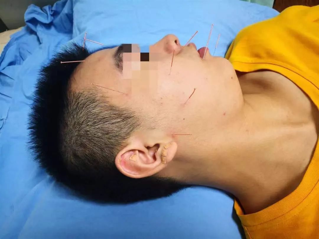 寒风吹出面瘫怎么办区第三人民医院专家来支招