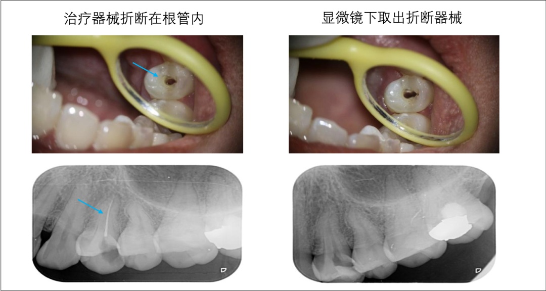 在传统根管治疗术中,医生只有凭借经验和感觉进行治疗,尤其是对于一些