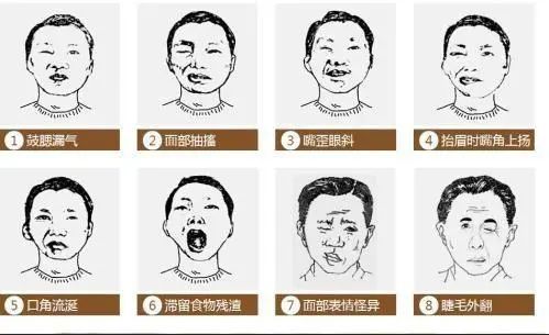 面神经麻痹是指面神经受损所致的面肌瘫痪,常见单侧面瘫,病侧口角歪斜