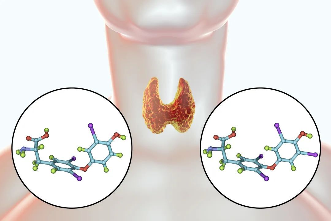 关注传说中的桥本甲状腺炎是个啥