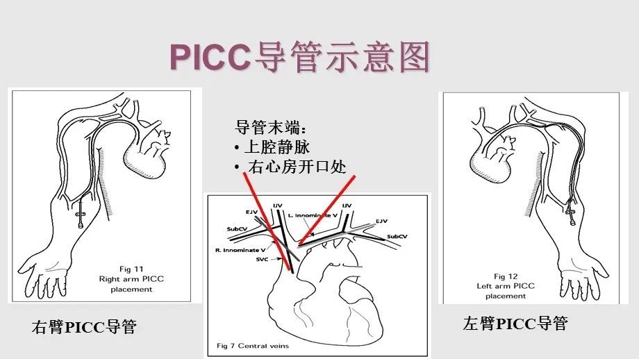 中心静脉示意图图片