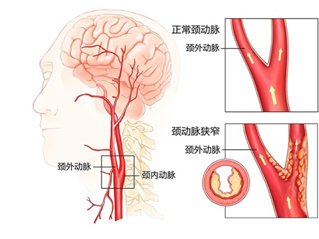 颈总动脉分叉处解剖图图片