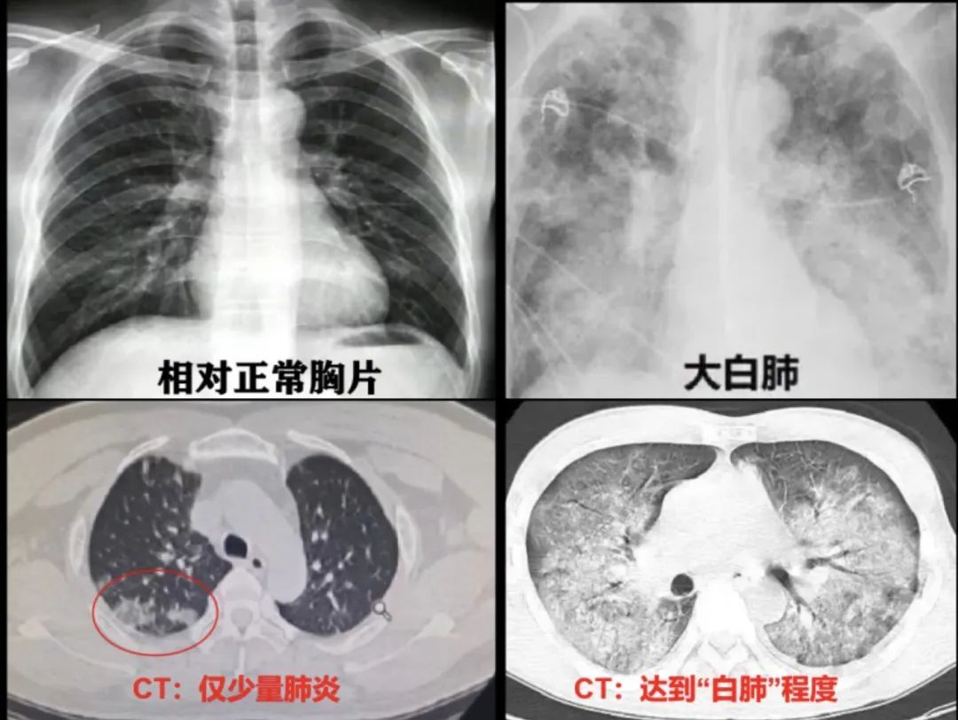 新冠肺炎ct影像图片