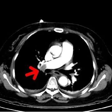 【同仁医线㉞】粉碎致命的肺栓塞(图2)