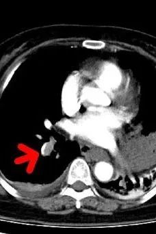 【同仁医线㉞】粉碎致命的肺栓塞(图1)