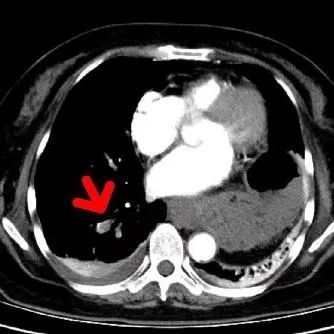 【同仁医线㉞】粉碎致命的肺栓塞(图3)