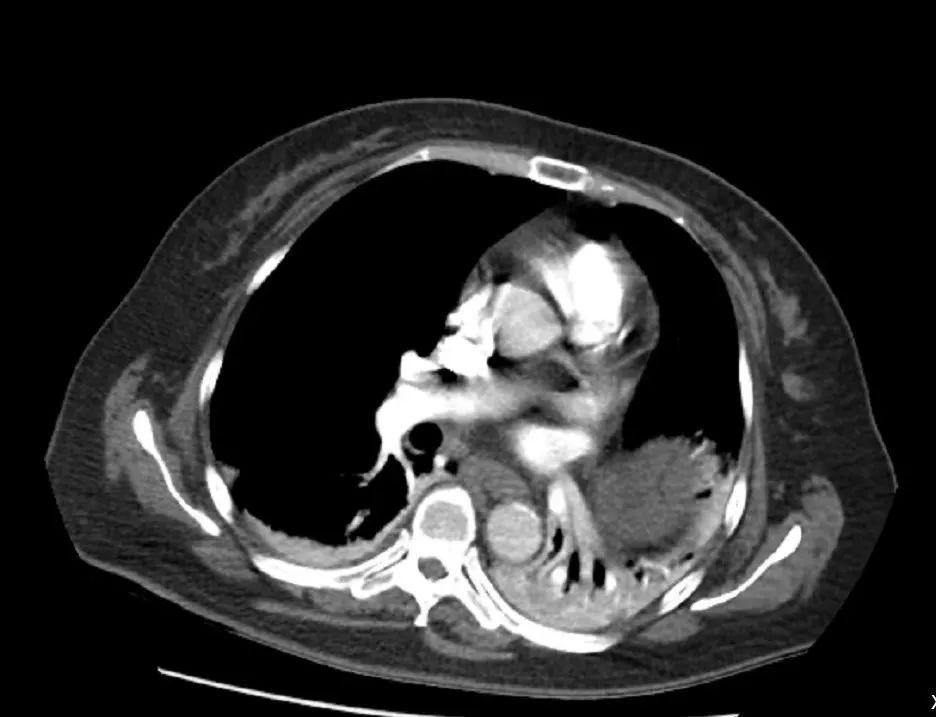 【同仁医线㉞】粉碎致命的肺栓塞(图10)