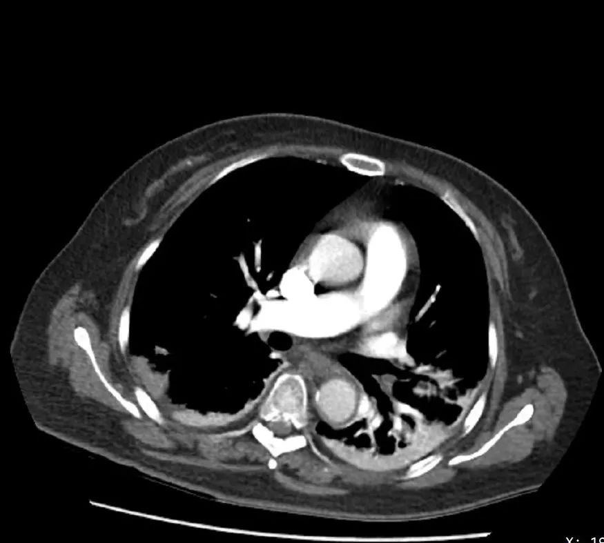 【同仁医线㉞】粉碎致命的肺栓塞(图9)
