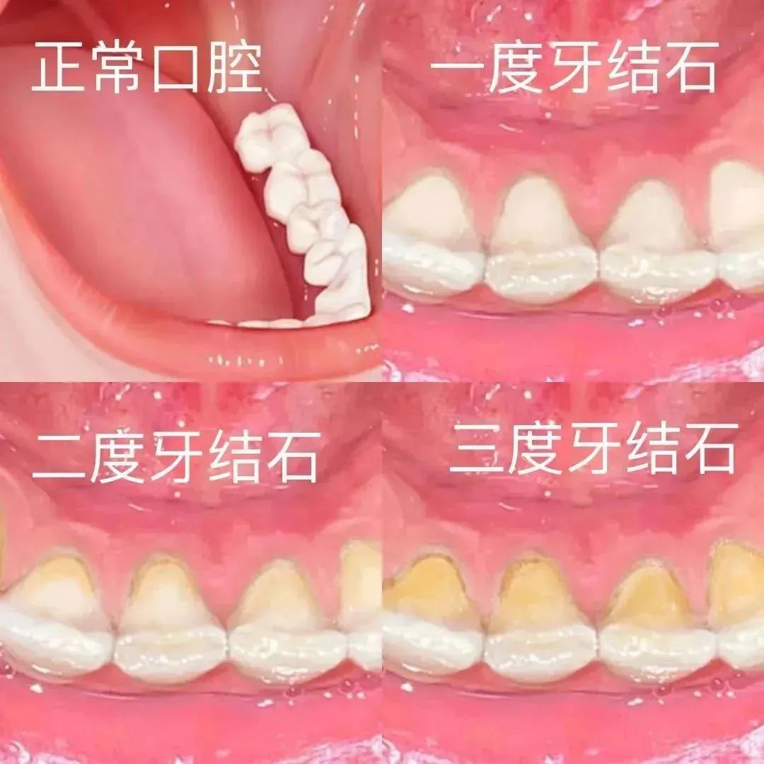 【健康口腔行动】关于洗牙的那些事儿-泾县中医院