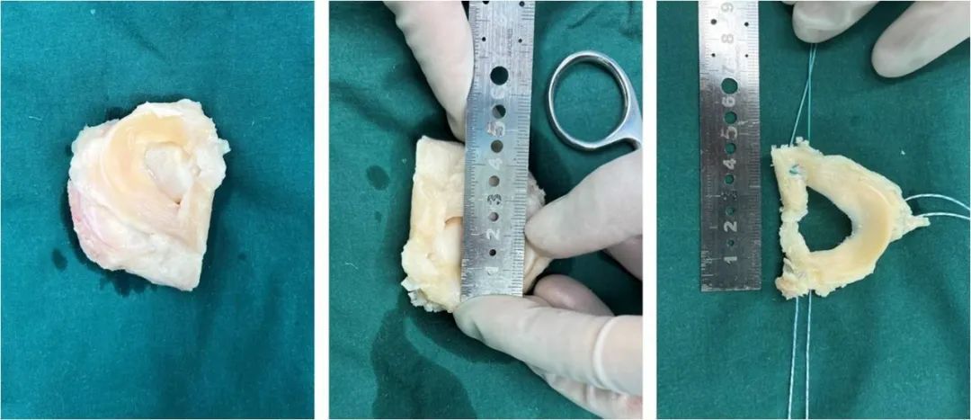 病案现场半月板缺失患者的福音同种异体半月板移植