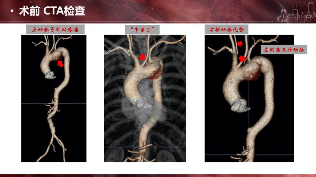 主动脉弓突出图片