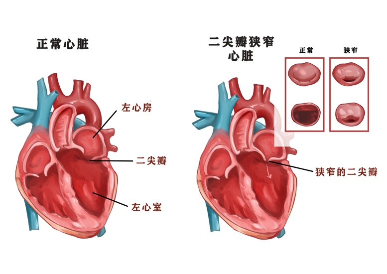 心脏瓣膜示意图简单图片