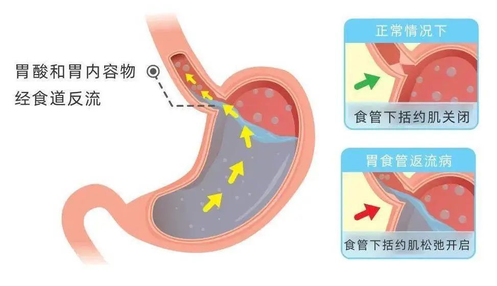 胃酸从耳朵里冒出来！？男子耳鸣一个月后被确诊…医生：与情绪饮食有关！职场人易中招！(图3)