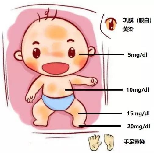 健康认识新生儿黄疸