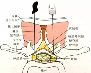 腰间盘突出小针刀图片