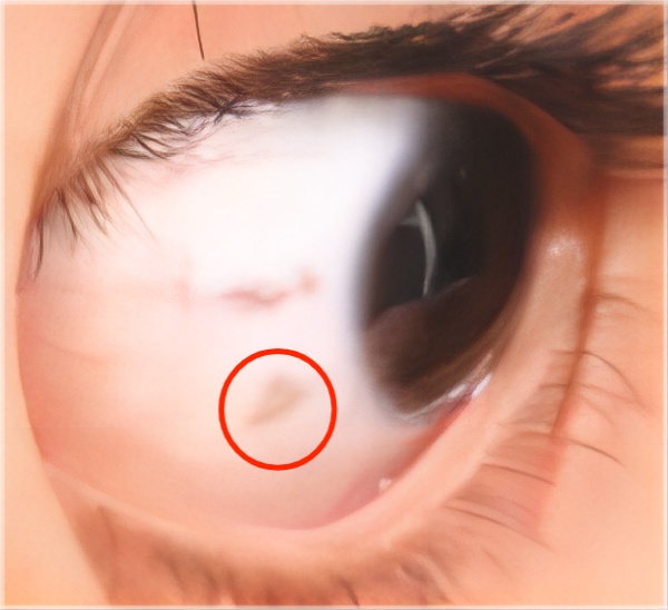 童声传递神经纤维瘤1型患儿迎来好消息