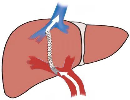 病案现场奋战6小时再通生命之桥一例肝硬化门脉高压tips支架闭塞再通